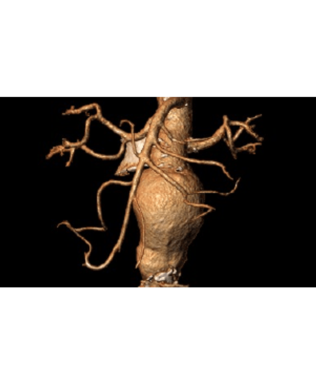 DESTAQUE APRIMORAMENTO MEDICO EM DOENCAS DA AORTA